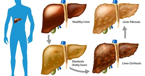 What Is Fatty Liver Disease Hep