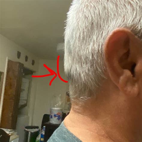 My Dad Has This Strange Lump On The Back Of The Head He