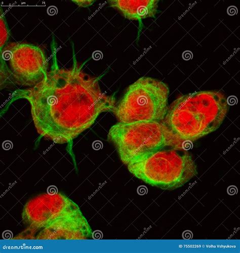 Real Fluorescence Microscopic View Of Human Neuroblastoma Cells Stock