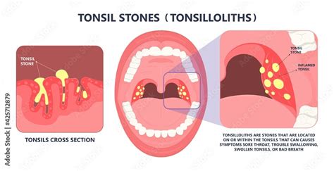 Tonsil Stones Crypts Viral Virus Gland Strep Throat Sore Enlarged Lymph