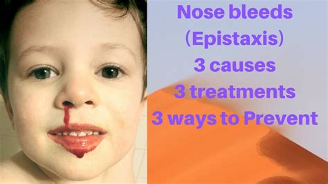 Nose Bleeds Epistaxis In Children 3 Causes 3 Ways To Treat And 3 Ways