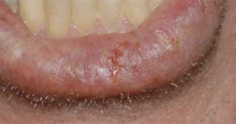 Oral Cancer Screen Sydney Holistic Dental Centre