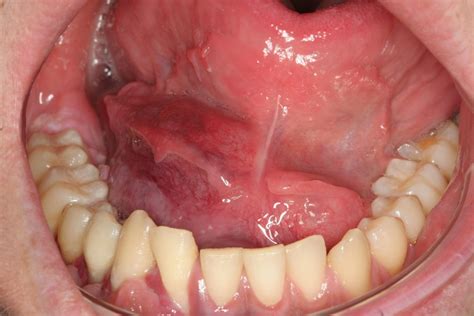 Ewing Sarcoma Of The Mandible Mimicking An Odontogenic Abscess A Case
