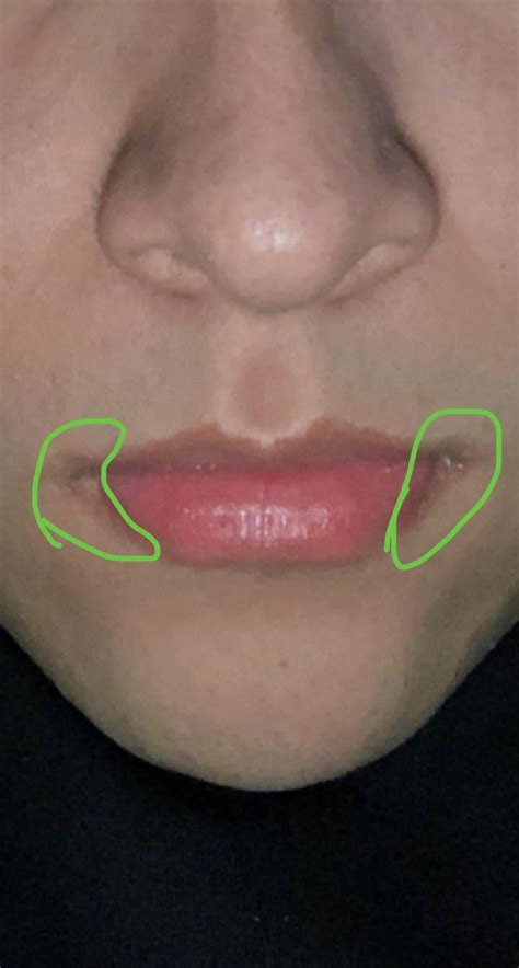 Skin Concerns Ive Had These Dark Spots At The Side Of My Lips For A