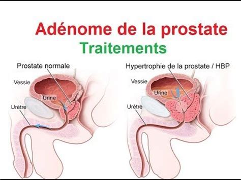 Adenome de la Prostate Cours de Médecine Etude medecine Cours