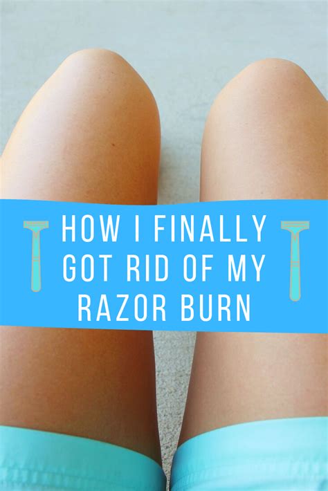 How I Got Rid Of My Razor Burn Optimum Rise Marketing Lifestyle Razor Burns Razor Bumps