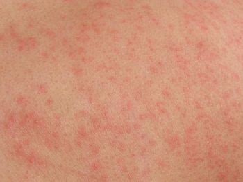 Check spelling or type a new query. Skin Allergic Reaction | Health Food Nutrition