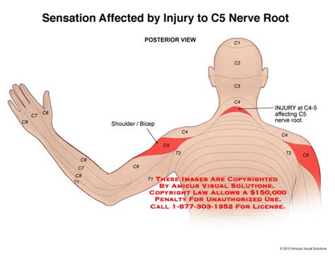 Sensation Affected By Injury To C5 Nerve Root