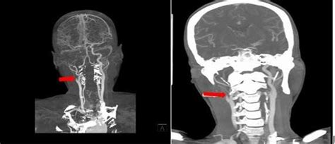The Right Internal Carotid Artery Occlusion On Brain Neck CT