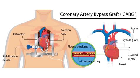 Coronary Artery Bypass Grafting Cabg Gleneagles Hospital