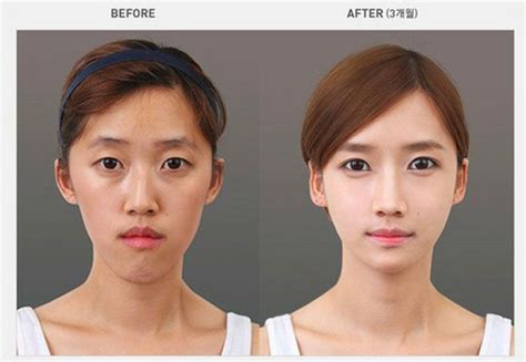 Korean Smile Line Surgery