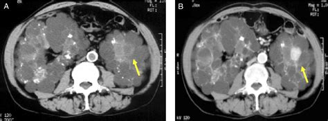 Figure 1 From Renal Cell Carcinoma In Autosomal Dominant Polycystic