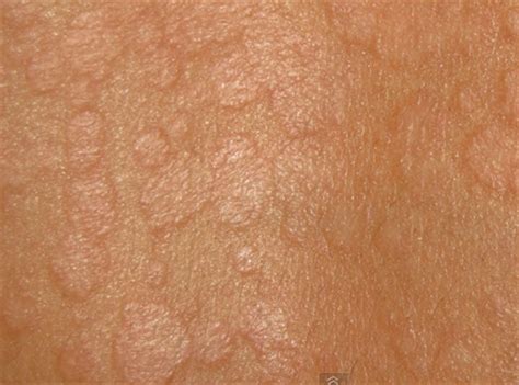 It is caused by overgrowth of a yeast that is normally present on the skin. Tinea versicolor - pictures, symptoms, causes, treatment
