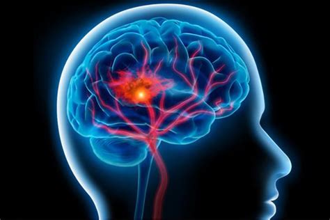 Înțelegerea Accidentului Vascular Cerebral AVC Cauze Simptome și