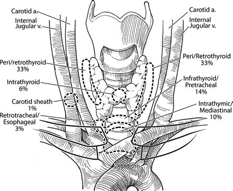 Revision Parathyroid Surgery Operative Techniques In Otolaryngology