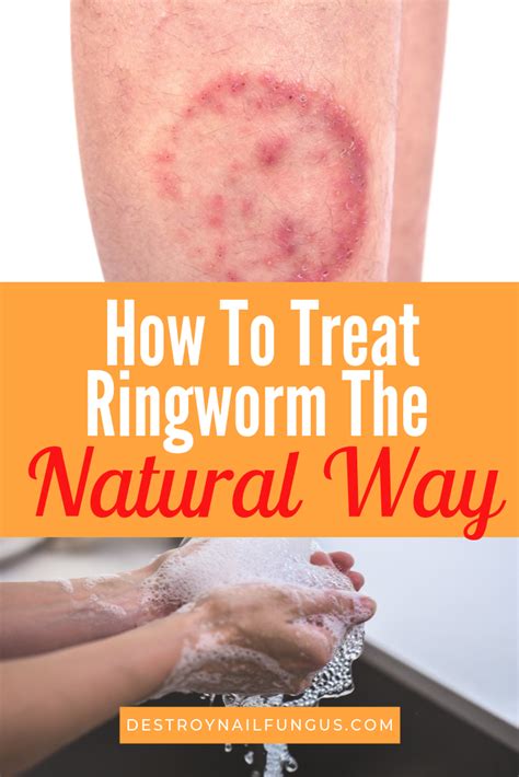 How To Treat Ringworm The Natural Way What You Need To Know