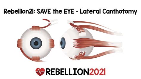 Rebellion21 Save The Eye Lateral Canthotomy Via Andy Little Do