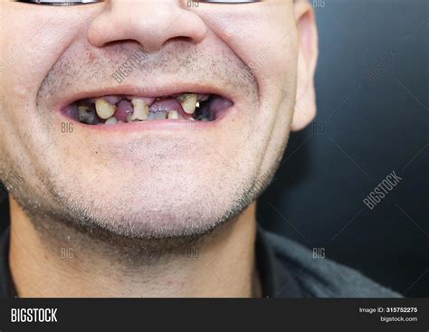 Man Has Rotten Teeth Image And Photo Free Trial Bigstock