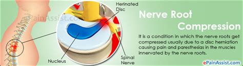 Nerve Nerve Root Compression