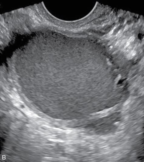 Cystic Adnexal Lesions Radiology Key