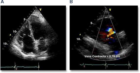 Echocardiographic Assessment Of Right Ventricular Function How To