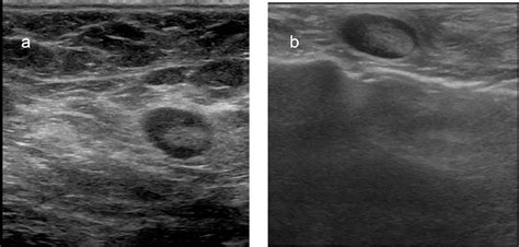 Lymph Node Predictive Model With In Vitro Ultrasound Features For