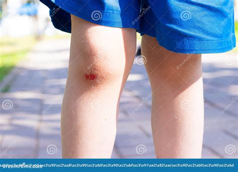 The Wound On The Child`s Leg Fell On The Road Broken Knee Health