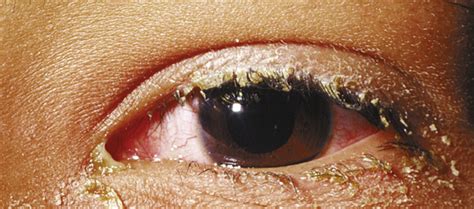 Sie kann unterschiedliche ursachen haben. Conjunctivitis (Pink Eye) | Anesthesia Key