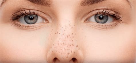 How to get rid of blackheads at home? The Best Advice For Removing Blackheads From Your Nose ...