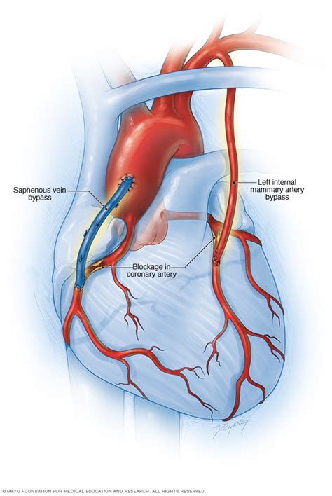 Coronary Artery Bypass Surgery Mayo Clinic 2023