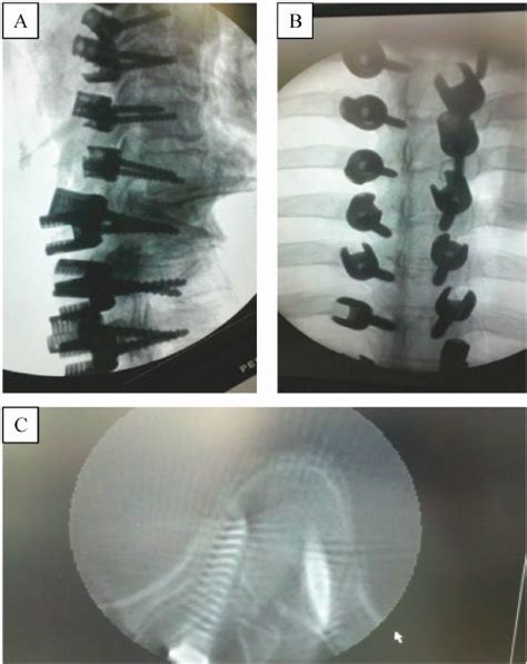 A Novel Entry Point For Pedicle Screw Placement In The Thoracic Spine