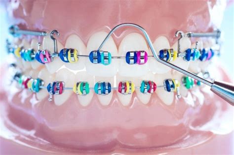 modelo de ortodoncia y herramienta de dentista modelo de dientes de demostración de variedades