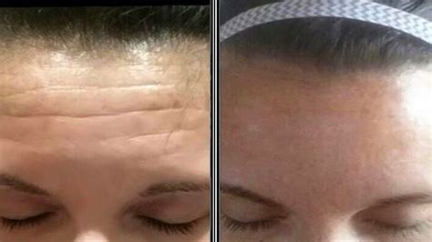 Fastest Ways To Get Rid Of Forehead Wrinkles And Forehead Lines Deep