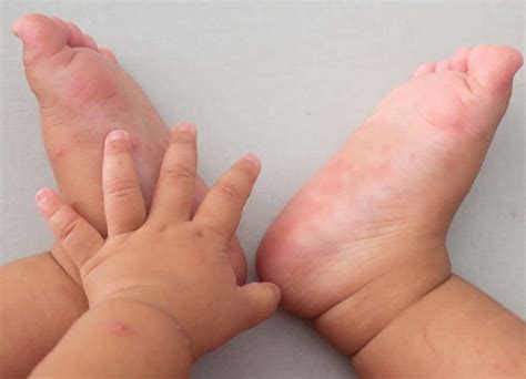 how to recognise the symptoms of hand foot and mouth disease