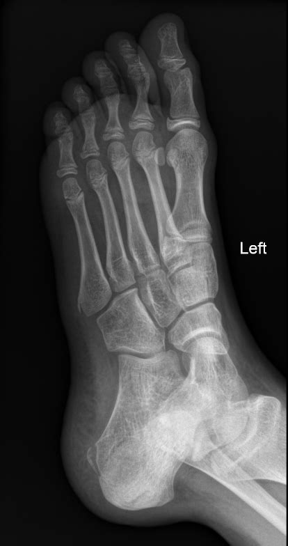 Normal Apophysis Of Proximal 5th Metatarsal Image