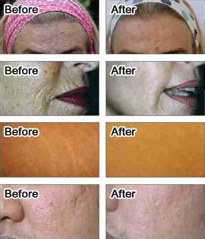 Dermaroller Before And After Pores Derma Roller Also Helps To Enhance