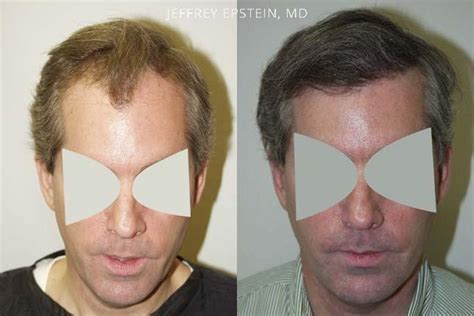 Hair Transplants For Men Photos Miami FL Patient38724