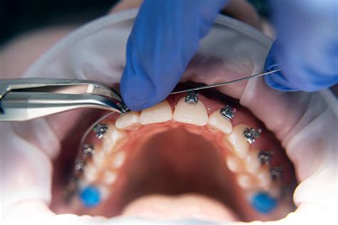 How To Handle A Braces Emergency Fravel Brewer Orthodontics