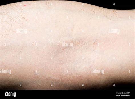 Superficial Thrombophlebitis In The Arm Of An 81 Year Old Man