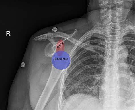 Anterior Shoulder Dislocation Prereduction Ap Xray Annotated Jetem