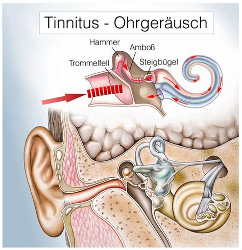 Menière Krankheit Morbus Menière Ursachen Symptome Und Behandlung