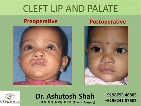Cleft Lip And Palate Treatment Surat Gujarat India