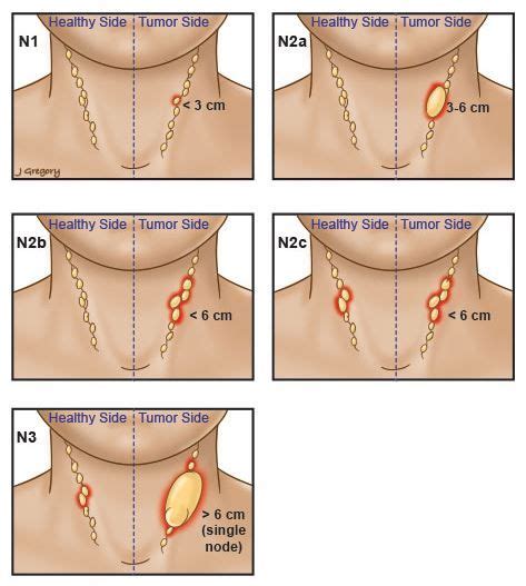Early Stage Cancer Lymph Nodes In Neck Tewsprojects