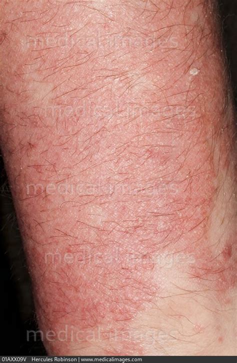 Stock Image Dermatology Psoriasis Spreading And Raised Pink Patches