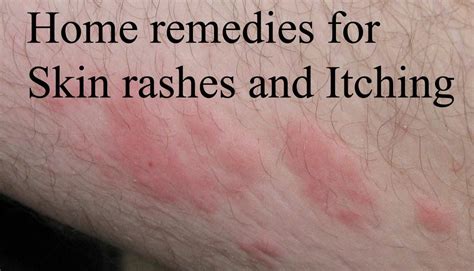 Best Home Remedies For Skin Rashes And Itching Online Bee Home