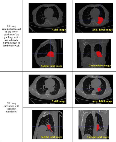 Cmc Free Full Text Multilevel Attention Unet Segmentation Algorithm For Lung Cancer Based On