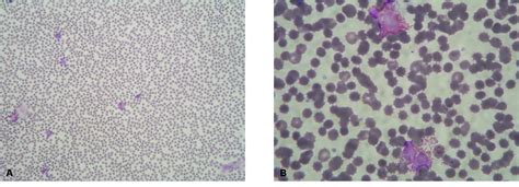 Figure 1 From A Case Of Eosinophilia As A Manifestation Of
