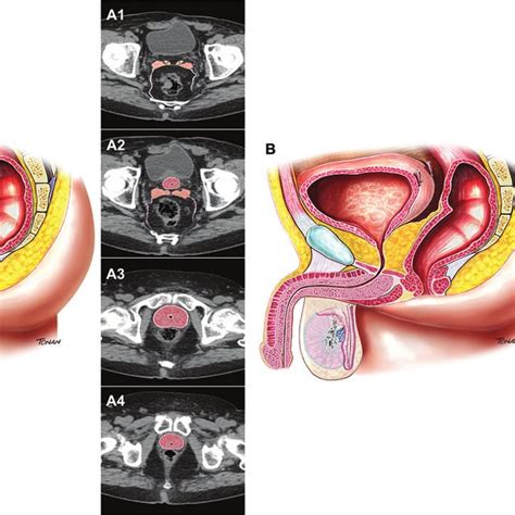 Biochemical Recurrence Psa Level Ng Ml In A Year Old Patient