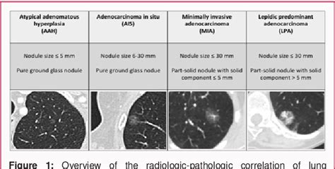 Figure 1 From Radiologic Pathologic Correlation In Lung Cancer