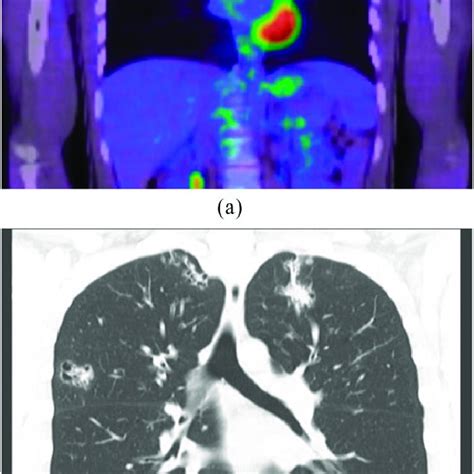 Airways And Lung Involvement In Rosai Dorfman Disease Coronal Contrast
